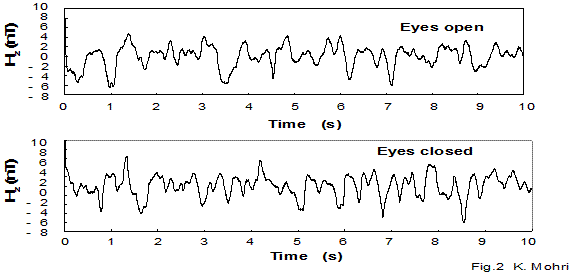 脊髄磁気検出例